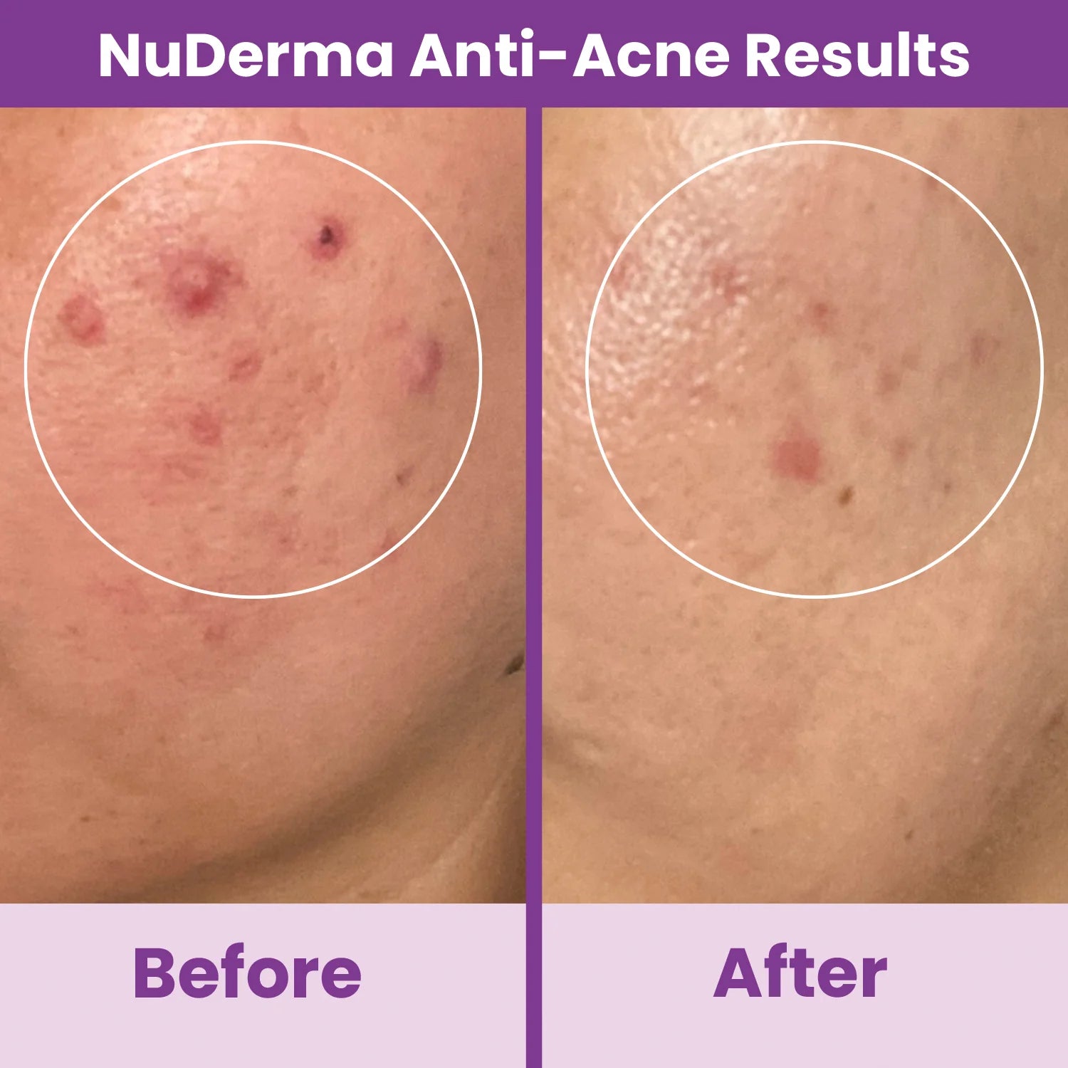 Nuderma Standard High Frequency Wand